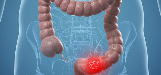 11 Home Remedies For Colon Cancer