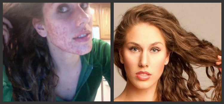 Get Rid of Annoying Pimples the Easy Way