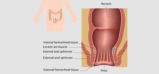 Home Remedies For The Embarrassing Problem Of Piles