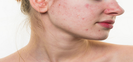 Is Acne Bothering You? Try Changing Your Face Care Routine