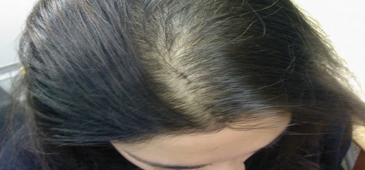 Balding in Women – All That You Need to Know