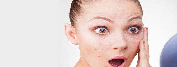 Top 5 products to fight those stubborn acne and pimples