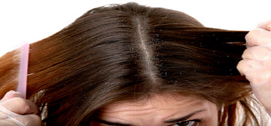 A Permanent Cure To All Your Dandruff Problems