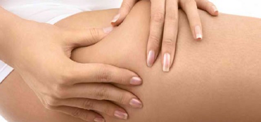 How does cellulite formation happen-how to prevent it