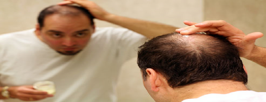 Deal with Balding Issues Effectively