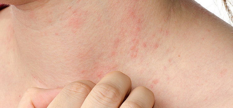 Tips to Cure Psoriases Naturally