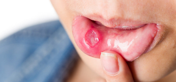 Quick Tips to Heal Mouth Ulcers