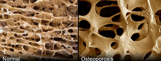 5 great deals for osteoporosis