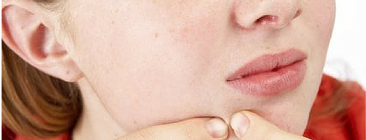 Do anti acne treatments help? How?
