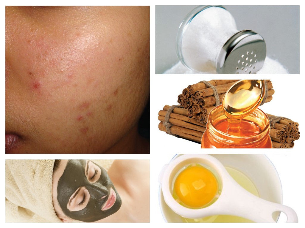 Why Use Organic Creams and Lotions for Acne and Pimple Care