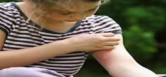 9 Home Remedies To Instantly Soothe Bug Bites