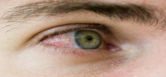 6 Home Remedies For Treating Redness In Eyes