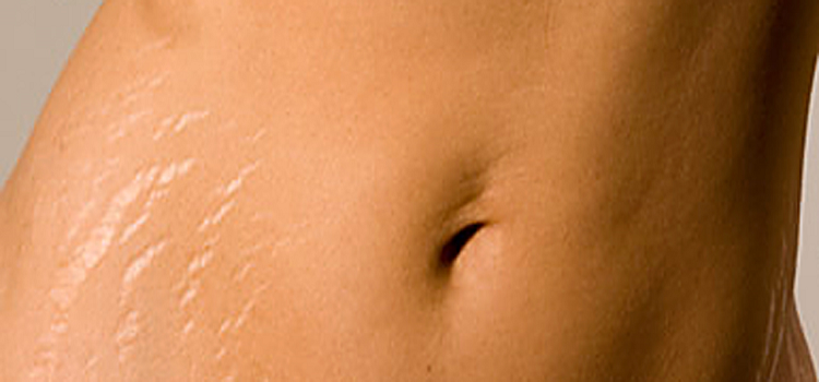 How to choose the best anti stretch marks cream?
