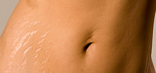 How to choose the best anti stretch marks cream?