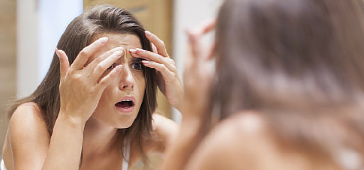 Acne and pimple creating a problem? worry no more