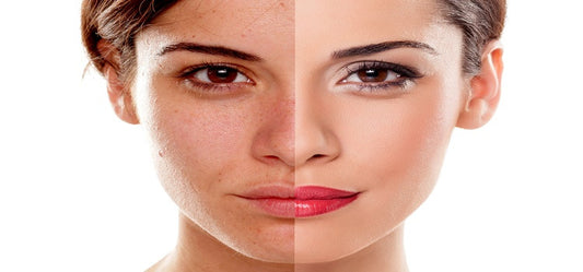 How To Have Spotless & Flawless Skin?
