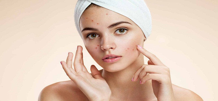 Want To Say Goodbye To Your Acne-Prone Skin?