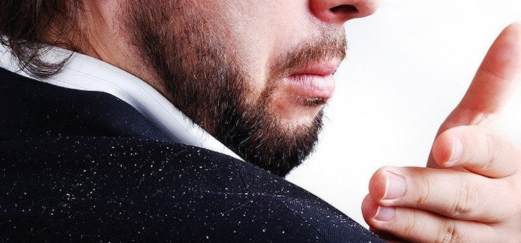 Why Curing Dandruff As Soon As Possible Is Important
