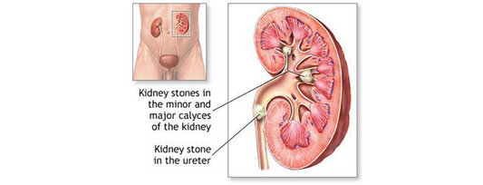 5 Organic and Natural ways to cure Kidney Stones