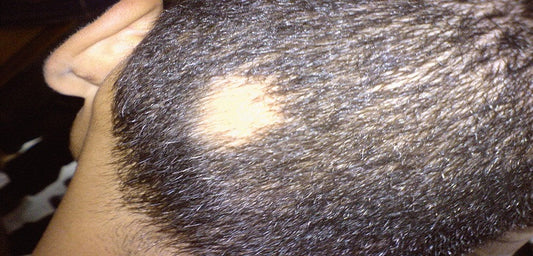 Alopecia Areata: Symptoms, Causes, Home Treatment