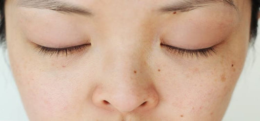 Say Bye Bye To Dark Patches