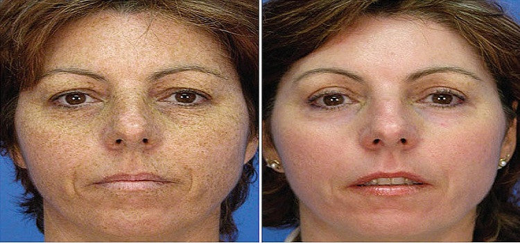 How To Remove Age Spots On Skin