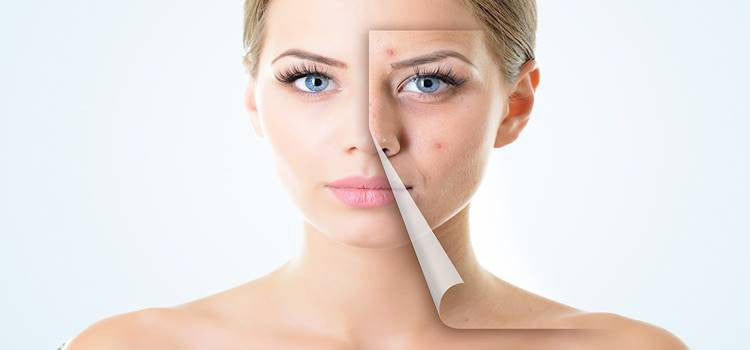 How to get rid of pimples on the skin