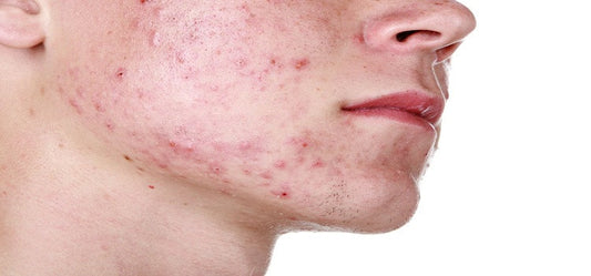 How To Tackle Acne Outbreak