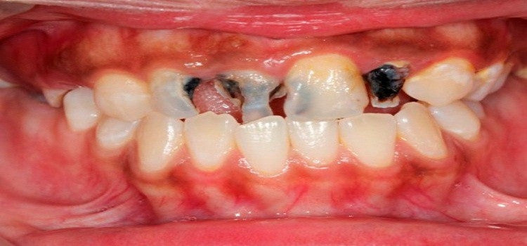 Prevent Cavities Before They Get A Chance To Form
