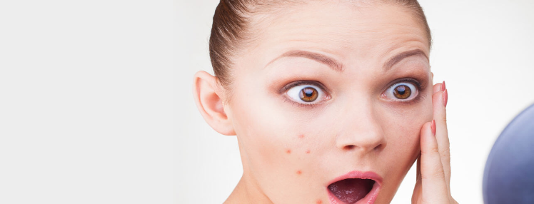 Acne depressing you? Get flawless skin in no time!