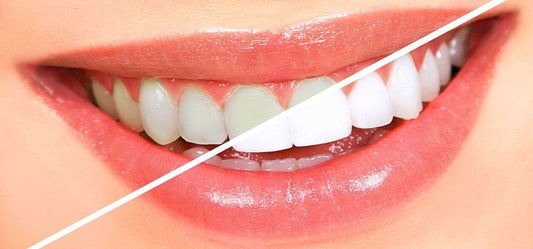 Get Rid Of Yellow Teeth With Natural Treatment