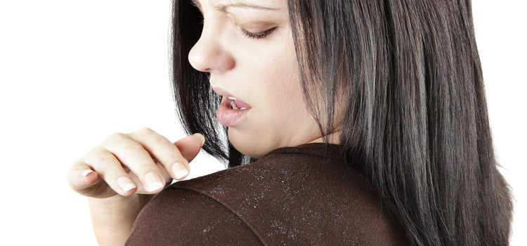 Surprising Home Remedies To Prevent Dandruff