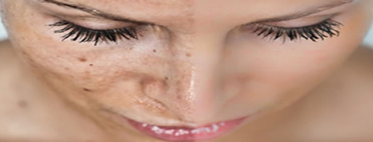 Is Pigmentation Speeding Up Your Ageing Process? Worry No More