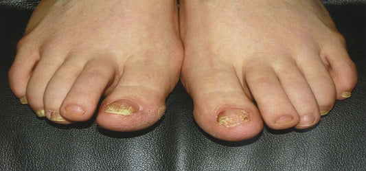 Simple Ways To Prevent Finger & Toe Nail Fungus