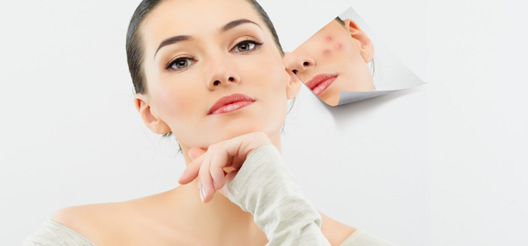 Remove The Marks Left Behind By Pimples