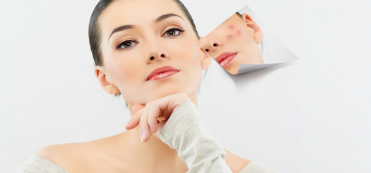 Remove The Marks Left Behind By Pimples
