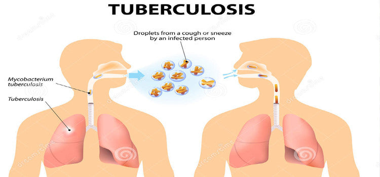 11 Home Remedies Of Tuberculosis